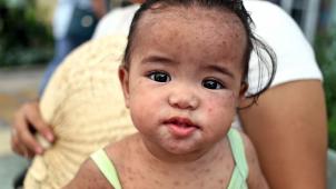 Selon un dernier rapport de l’OMS, le nombre d’enfants vaccinés contre la rougeole est plus élevé que jamais dans la région européenne de l’OMS. Mais pas de manière équivalente partout.