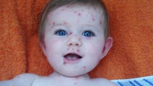 Le vaccin contre la varicelle a permis une forte diminution des infections
invasives à streptocoque. © D.R.