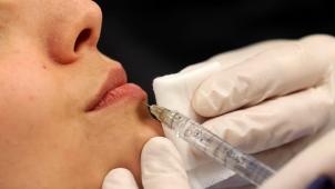 L’injection d’acide hyaluronique dansles lèvres fait partie des interventions prisées.