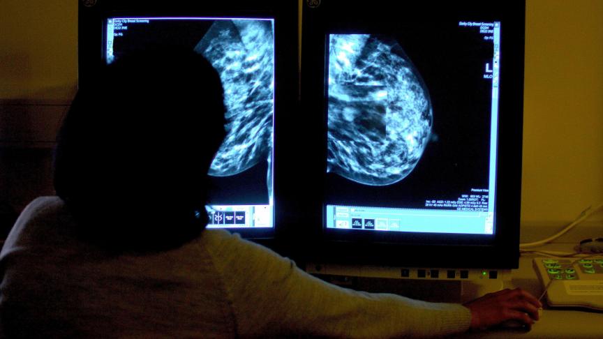 Les médicaments luttant contre le cancer du sein vont-ils se démocratiser
?