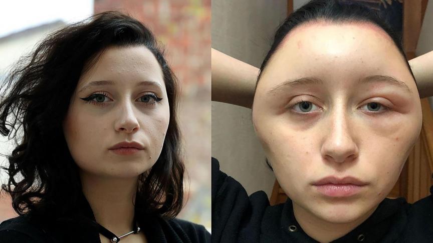 Estelle, une jeune étudiante française défigurée après une coloration pour cheveux. - D.R.