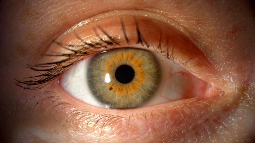 Cancer de l'œil: rare et insidieux, il existe - Soirmag