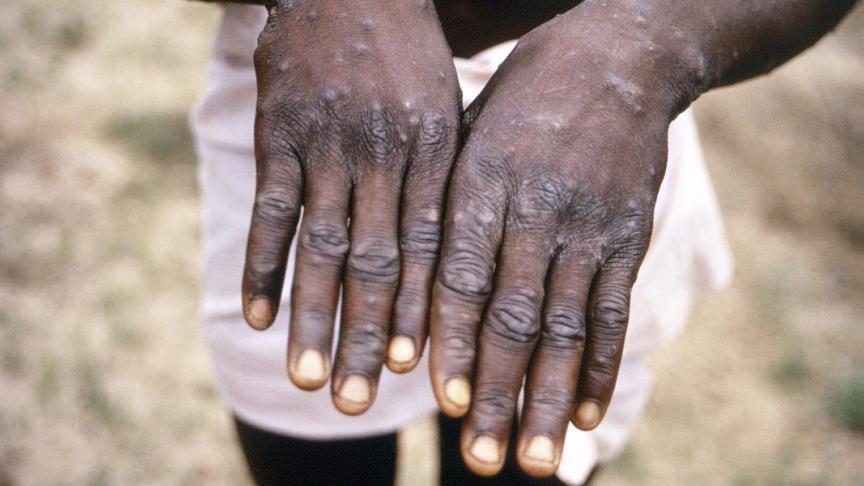 En 1997, les mains d’un habitant de la République démocratique du Congo, infecté par le virus de la variole du singe.