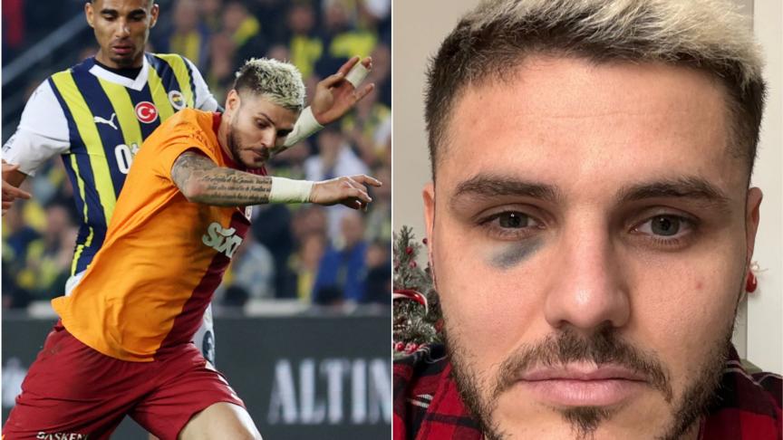 L'oeil au beurre noir de Mauro Icardi crée une nouvelle polémique dans le  football turc (vidéo) - Le Soir